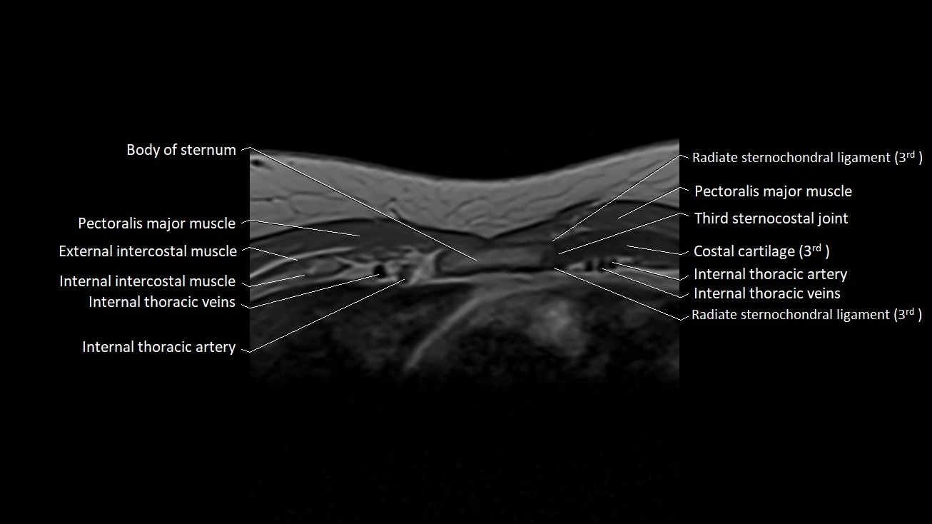 MRI sternum and sternoclavicular joint labeled axial anatomy image 17.webp